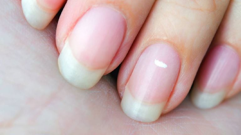 Qué vitamina falta cuando salen manchas blancas en las uñas?