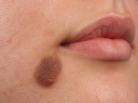 Congenital nevus of the cheek in a 20-year-old woman. (Photo by: GIRAND/BSIP/Universal Images Group via Getty Images)