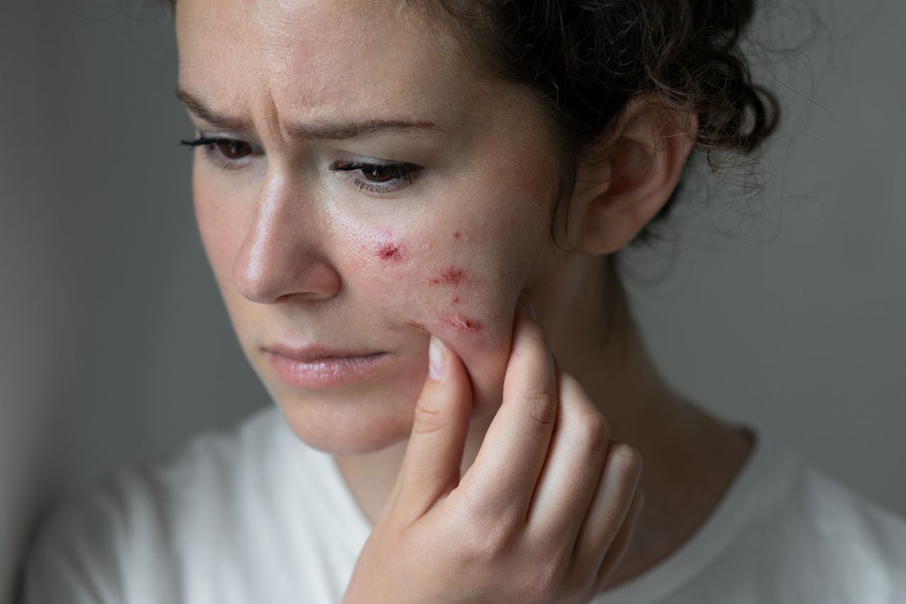 Cualquier persona puede sufrir de acné.