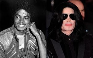 Michael Joseph Jackson​​ fue un cantante estadounidense que se sometió a un aclaramiento de piel, se operó la nariz, los ojos, la boca y los pómulos. También se realizó injerto de cabello.