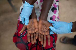 Alingo Likaka Manasse, enfermera jefe del Centro de Salud de Yalanga, examina las lesiones en las manos de Lituka Wenda Dety, de 41 años, que sufre de viruela del mono, en Yakusu, Tshopo, República Democrática del Congo, el 2 de octubre de 2022. 