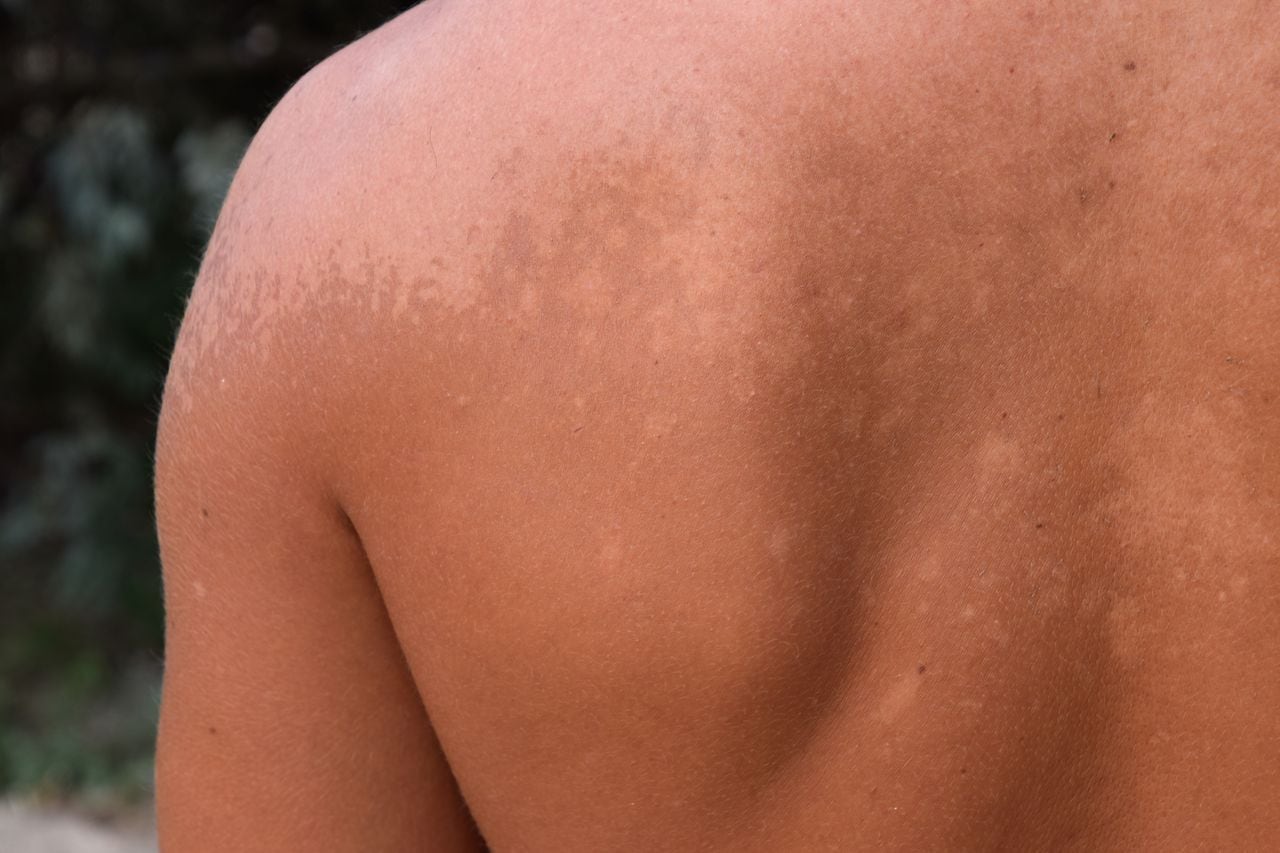 Detalle de hongo en la piel de la espalda