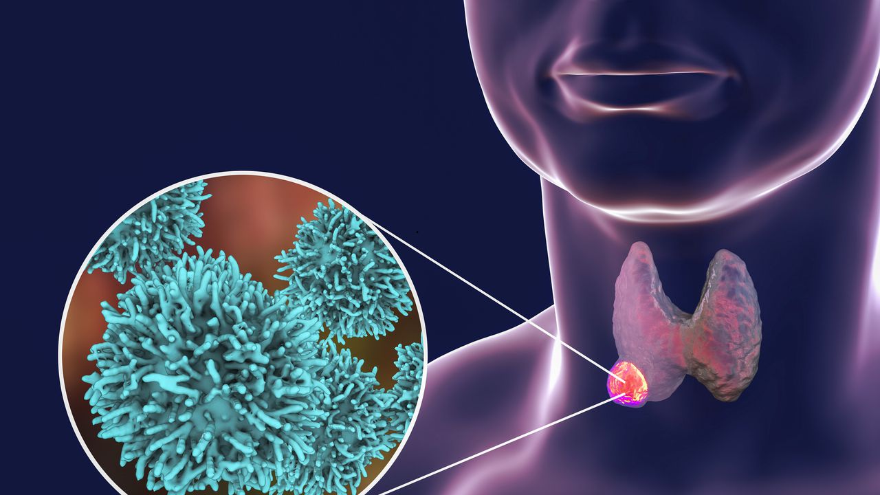 Cáncer de tiroides - Imagen de referencia