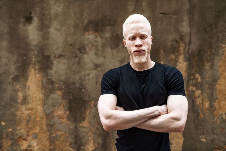 Hombre albino