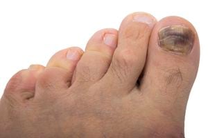 Fungal infection on the human toe. Psoriasis on the foot of an old man. Onychomycosis is a fungal infection of the big toe. Nail melanoma.