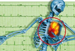 El estrés podría ser responsable del riesgo de infarto.