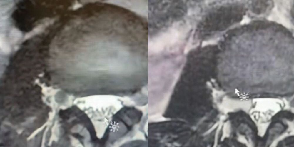 En la foto de la izquierda la radiografía con el tumor y en la de la derecha la radiografía que ya no muestra nada.