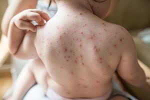 El 95 % de las personas pueden enfermarse de varicela a lo largo de su vida.