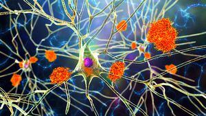Alzheimer's disease. Illustration of amyloid plaques amongst neurons and neurofibrillary tangles inside neurons. Amyloid plaques are characteristic features of Alzheimer's disease. They lead to degeneration of the affected neurons, which are destroyed through the activity of microglia cells.