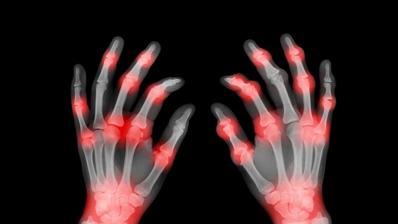 An x-ray of a pair of hands showing painful joints