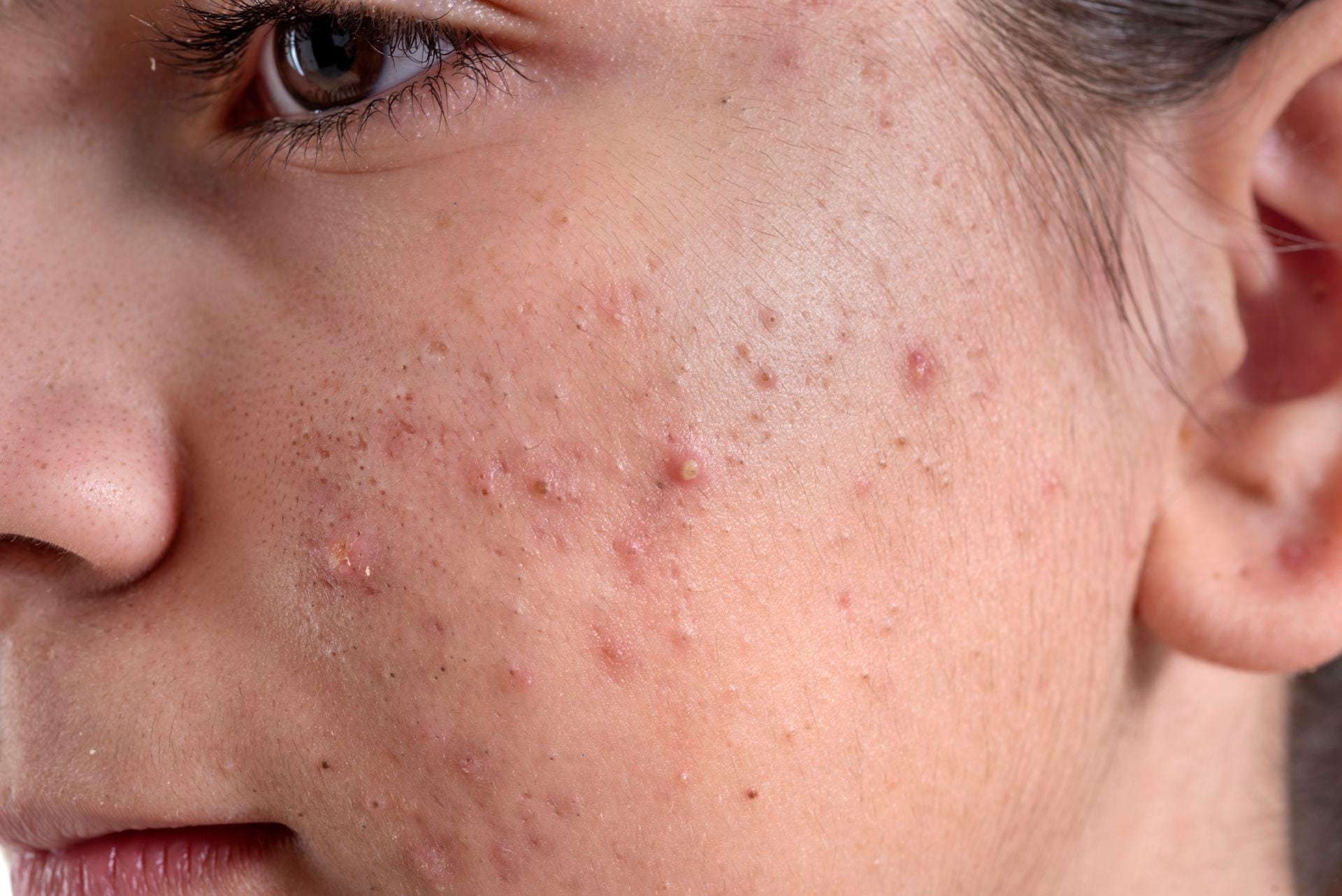 Angferbri: Mi experiencia con el acné [Motivos de aparición de los granitos  y remedios]