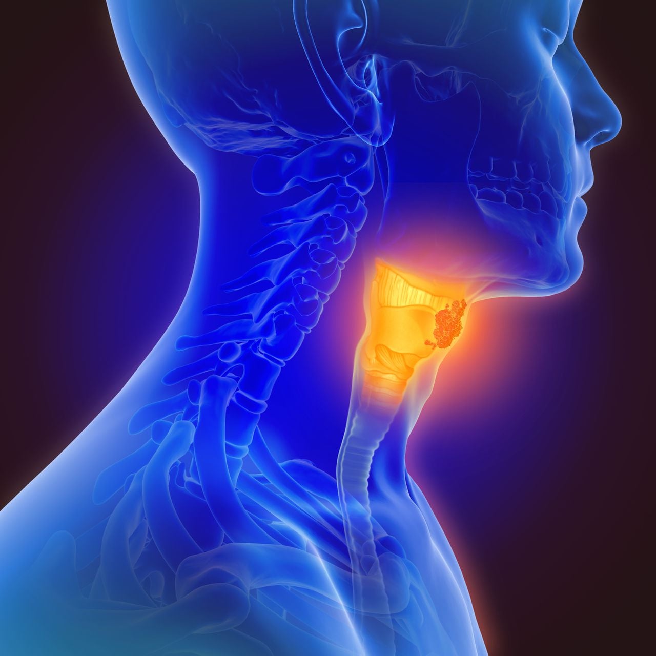 Ilustración 3D sobre cáncer de garganta