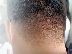 healthy problem."nThe small size of mole on occipital of the asian man