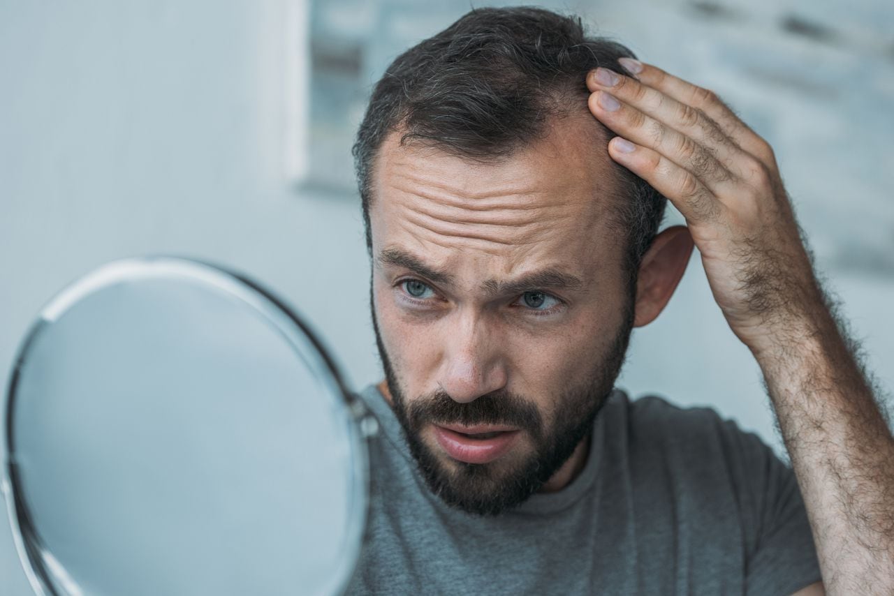 Hombre envejecido medio molesto con alopecia mirando en el espejo, concepto de pérdida de cabello. Calvicie.