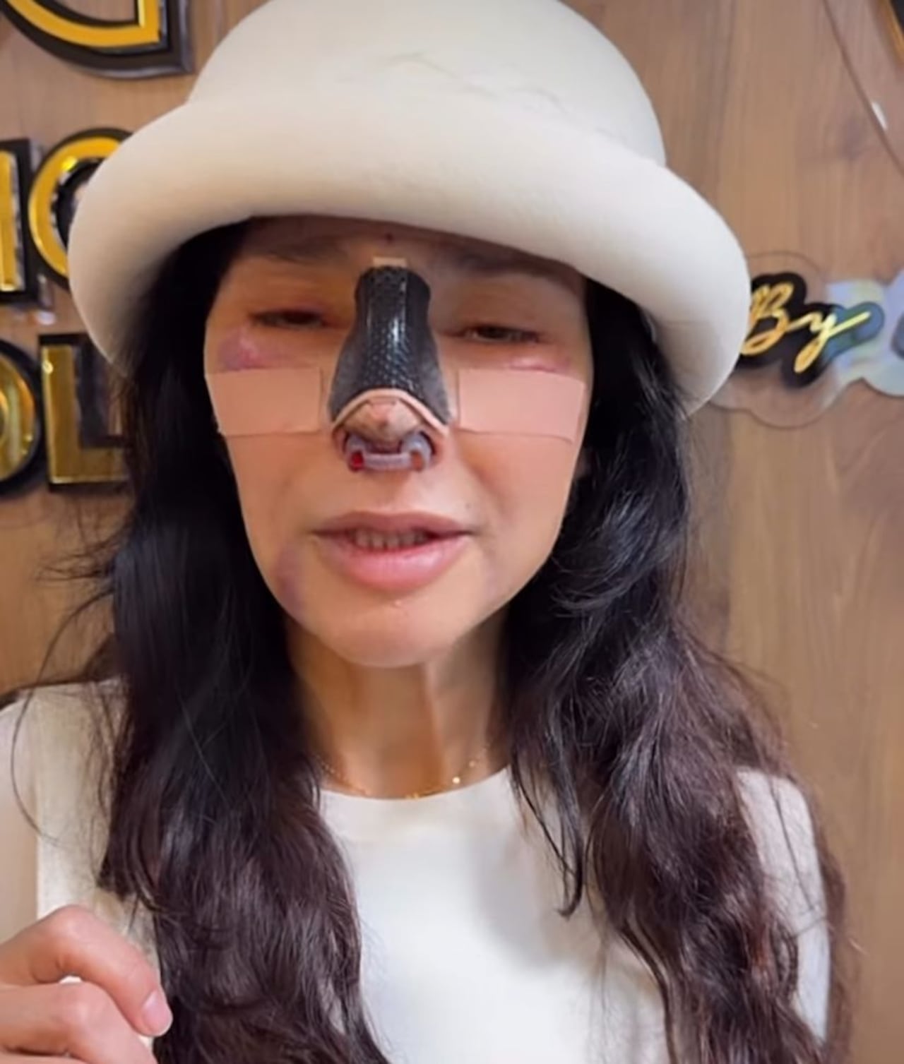 En sus historias, la actriz mostró cómo avanza su nueva cirugía.