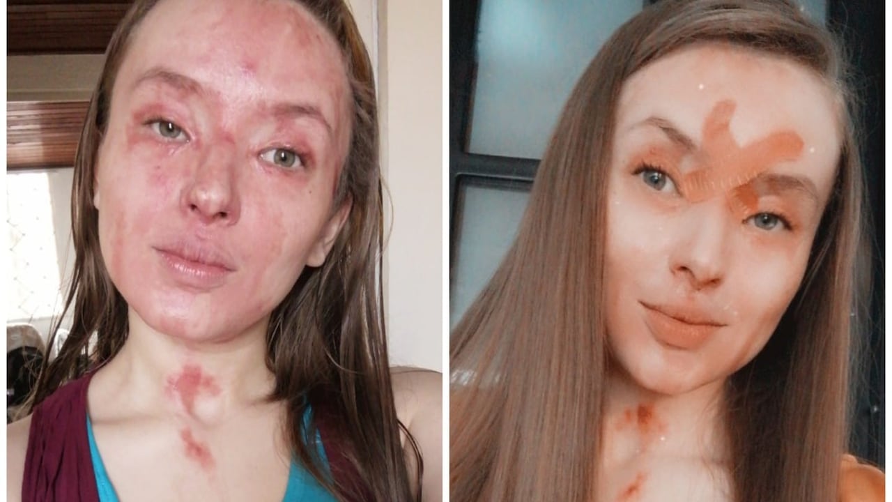 El mensaje de la mujer que fue atacada con ácido en Antonio Nariño