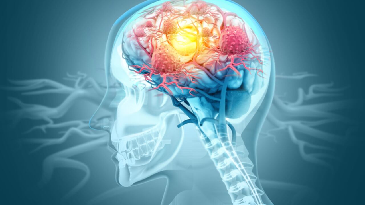 Células cancerosas atacando un cerebro humano. ilustración 3d