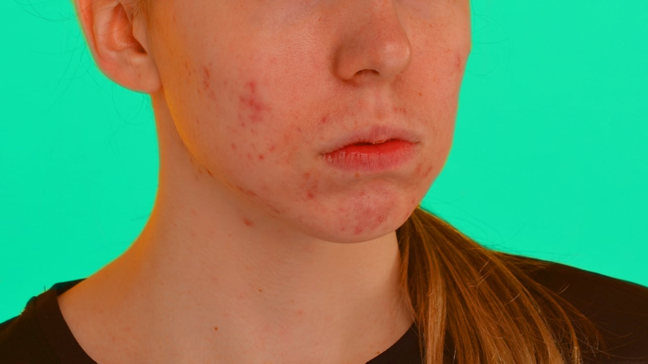 Los tratamientos médicos disponibles que pueden ayudar a recuperar una piel suave y uniforme después de la varicela han sido explorados en detalle.