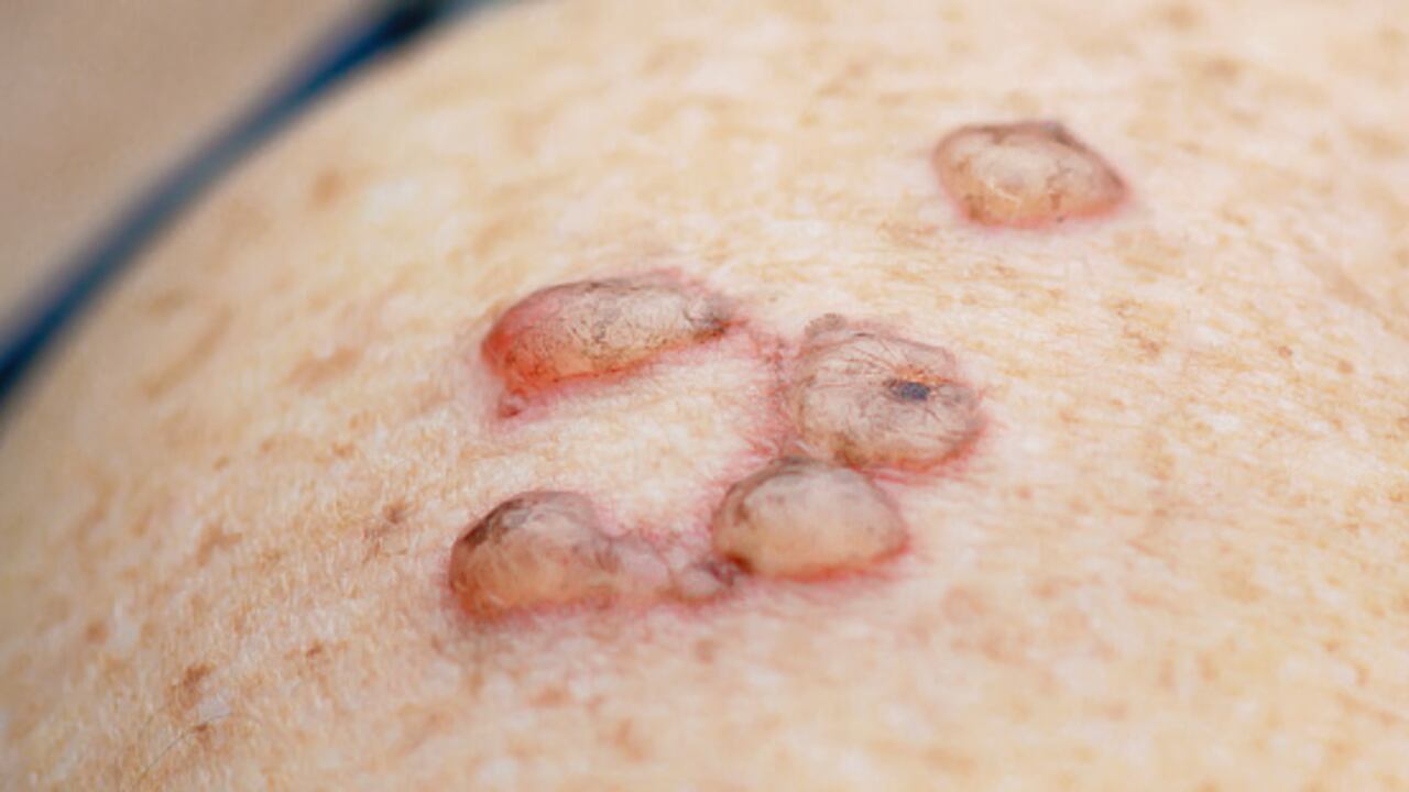 Verrugas, así se eliminan