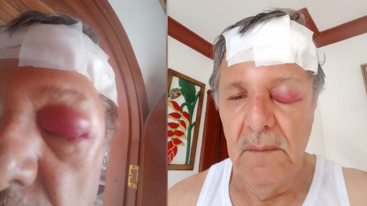 Hugo Romero fue agredido por un motociclista al norte de Cali.