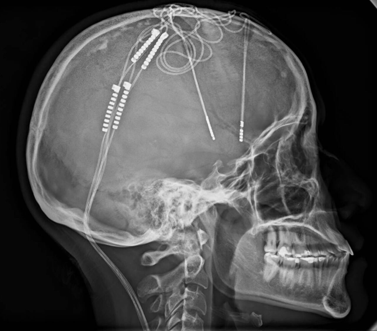 Estos son los electrodos que fueron colocados en el cerebro de Lorena.