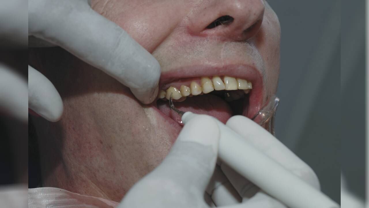 El sarro se produce por la acumulación de placa bacteriana.