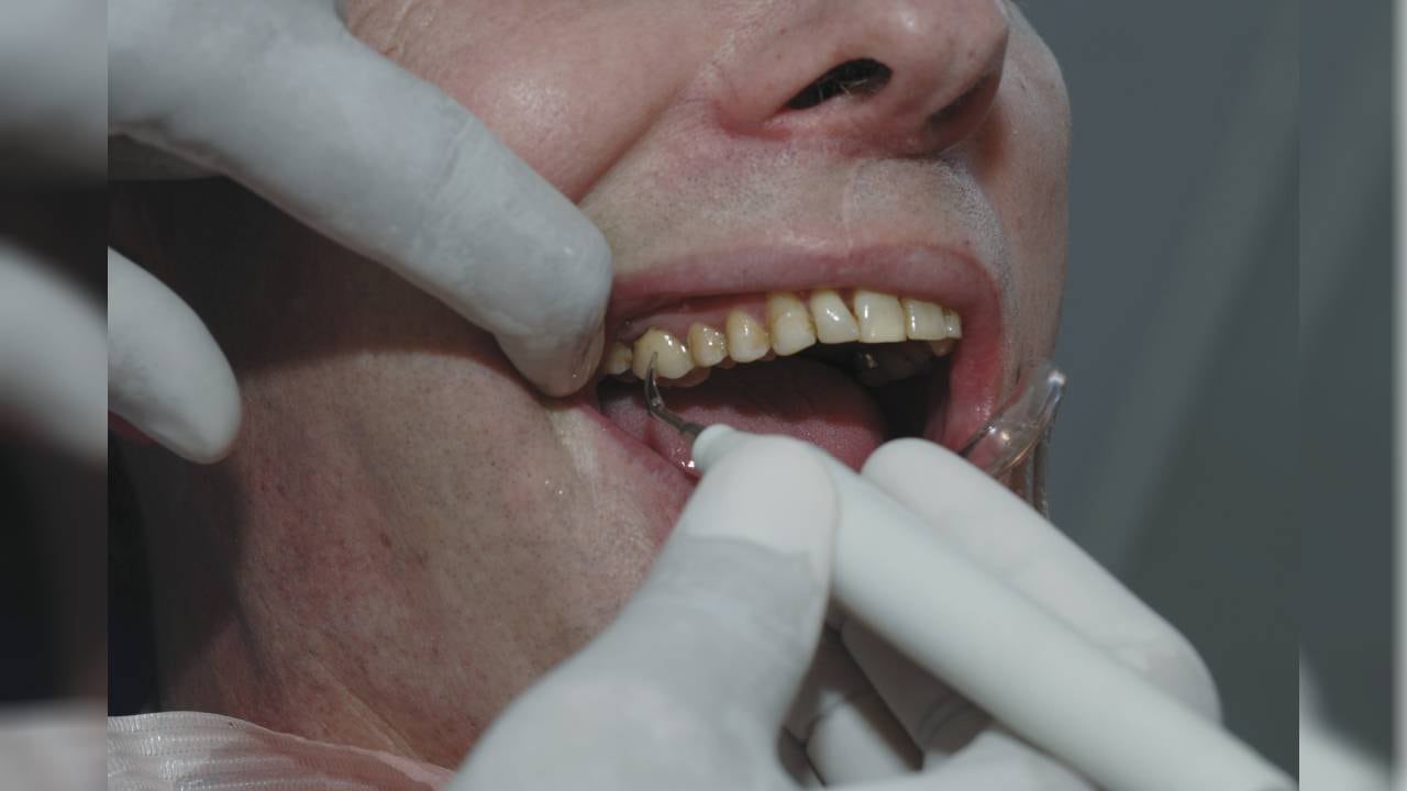 El sarro se produce por la acumulación de placa bacteriana.