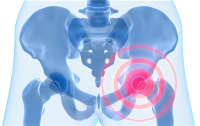 La osteoporosis se presenta por la pérdida de masa ósea. 