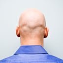 También conocida como alopecia. Foto: Getty Images.