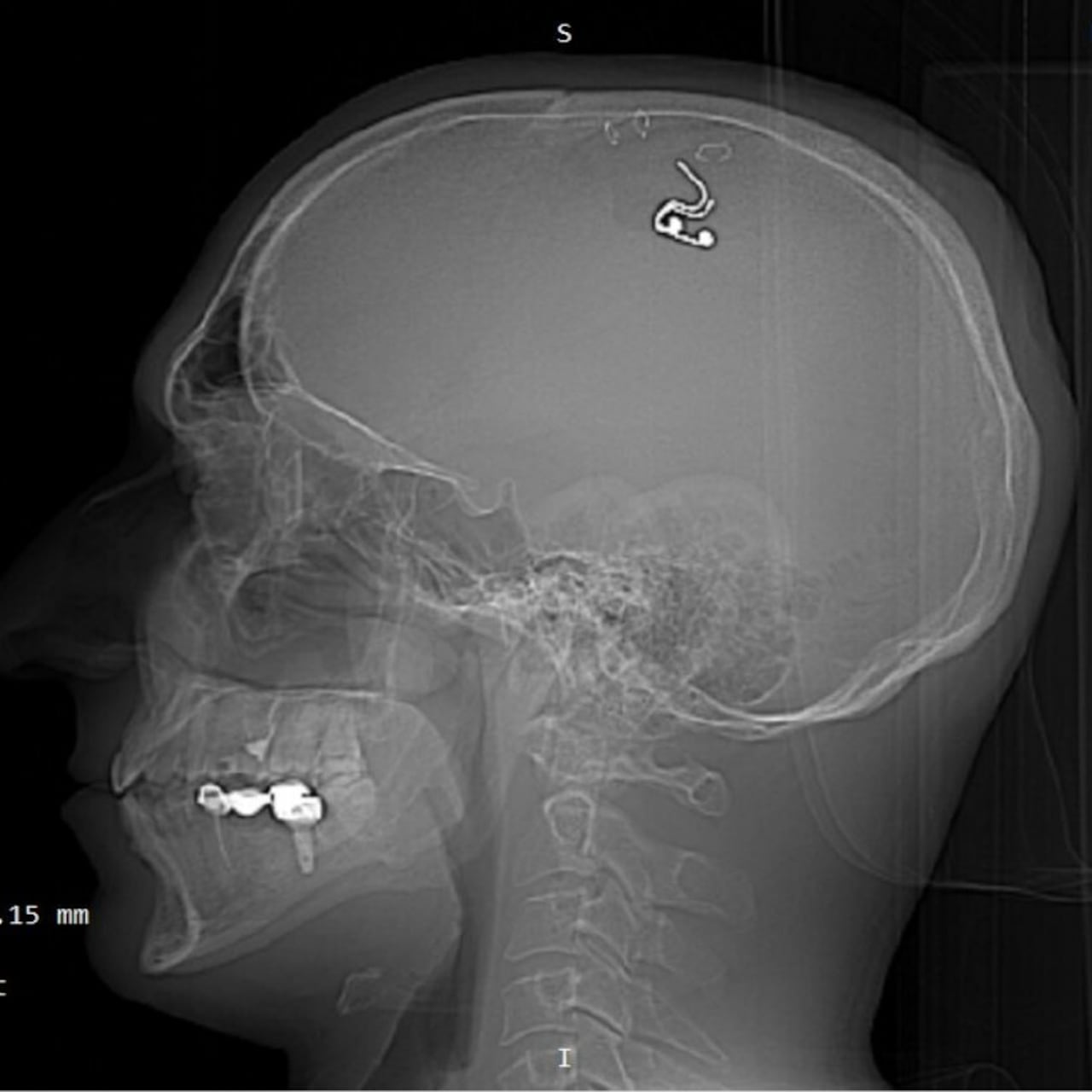 El hombre compró un taladro y él mismo se abrió el cráneo.