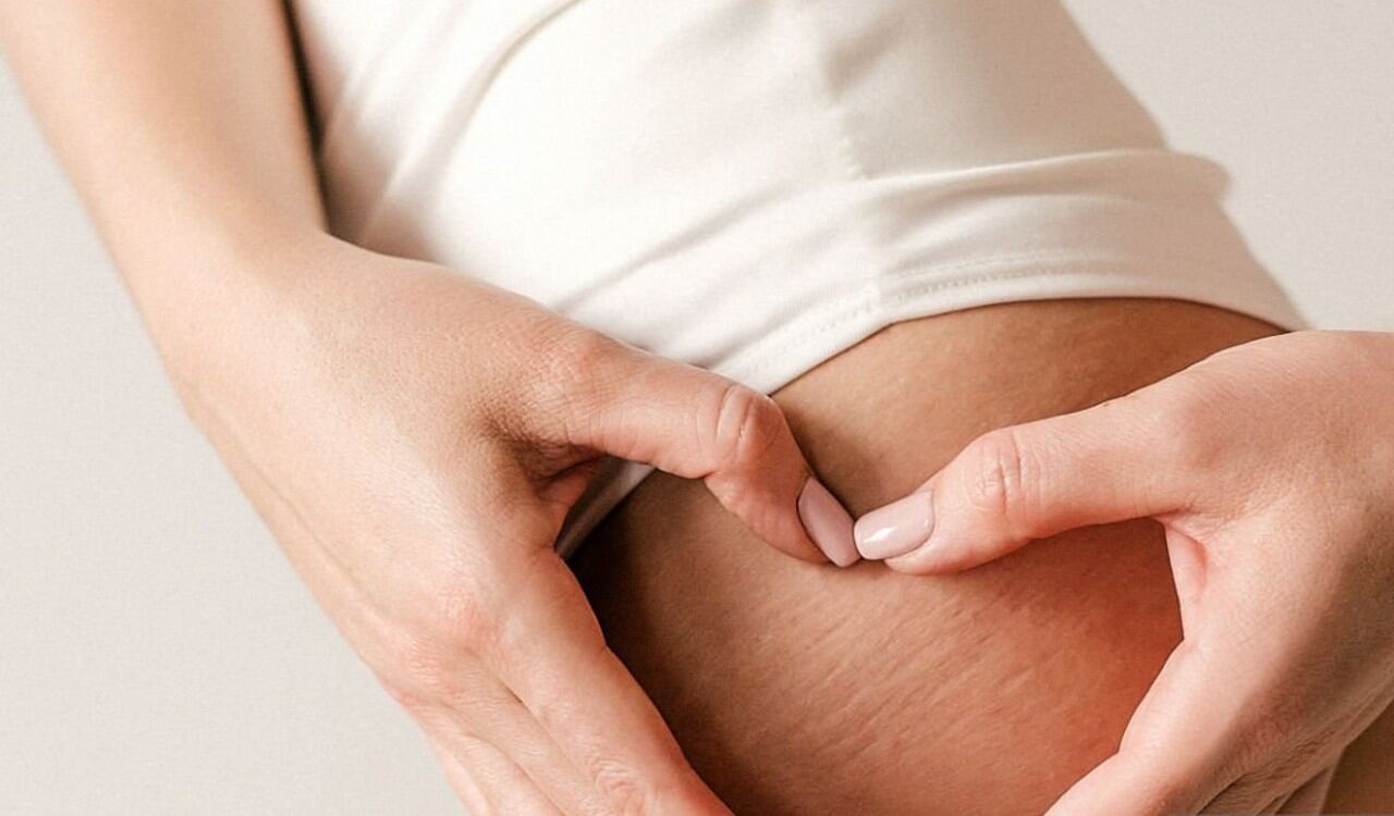 Hay varios tratamientos para reducir las estrías blancas