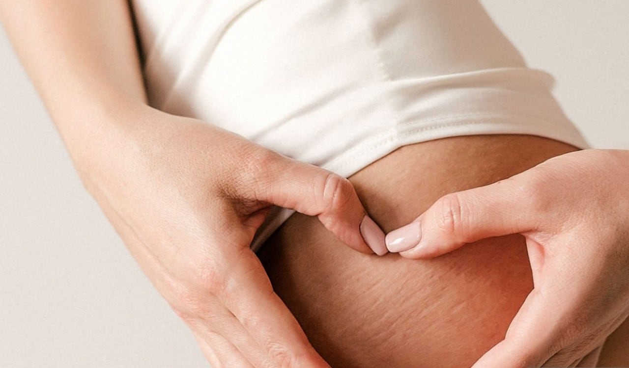 Hay varios tratamientos para reducir las estrías blancas