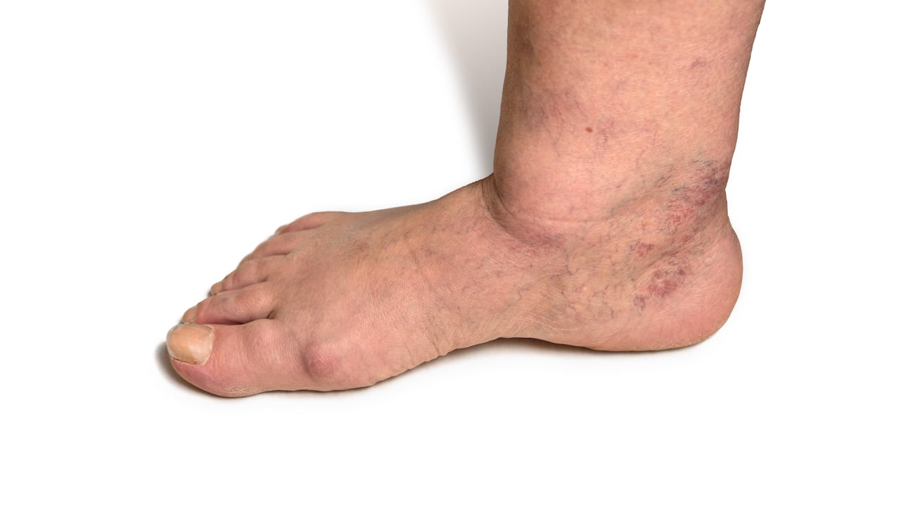 La diabetes mal controlada puede afectar los pies.