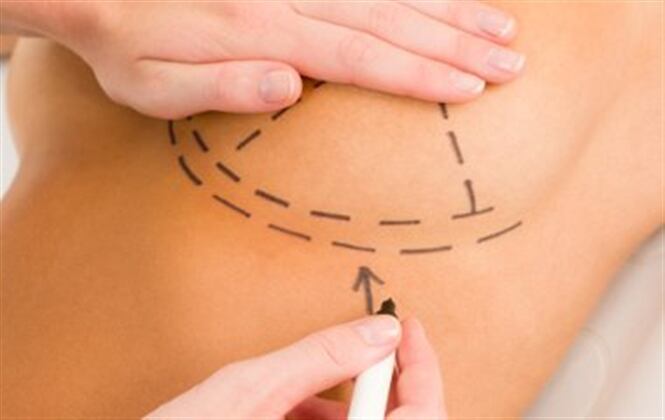 El retiro de implantes mamarios supuso alivio en las pacientes que expresaron malestares sin causas identificadas. Thinkstock