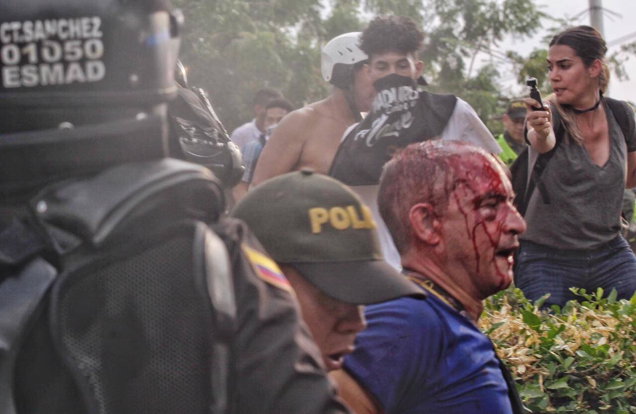 Este venezolano también sufrió lesiones durante el enfrentamientos entre civiles y la Guardia Nacional. Foto: Diana Rey Melo SEMANA