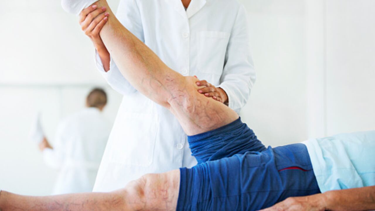 Las varices son de color azul oscuro o púrpura, y a menudo están retorcidas y abultadas debajo de la piel, diferente de las venas arañas, es decir, las líneas de venas rojas o azules mucho más pequeñas que puedes ver en la superficie de tu piel.