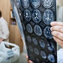 Así es como mueren las personas que padecen alzhéimer