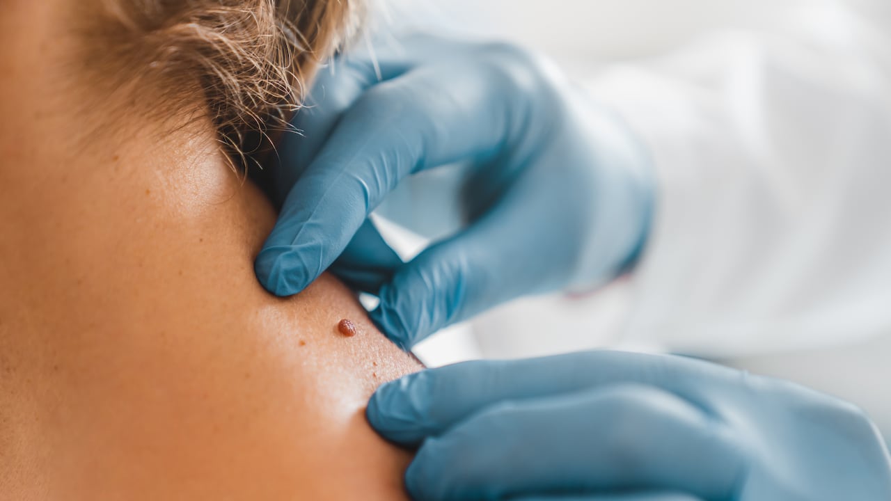 Hay diversos tipos de cáncer de piel y el melanoma es uno de los más comunes.