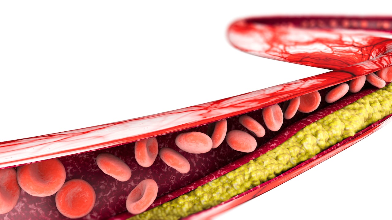Los altos niveles de colesterol pueden inducir a enfermedades cardíacas.
