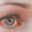 Ojo humano irritado rojo de cerca, síntoma de alergia