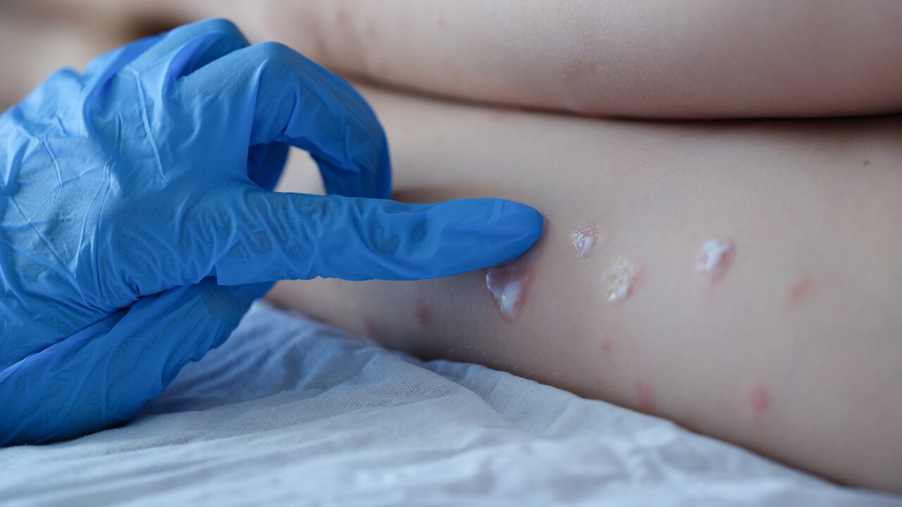 La viruela del mono es la nueva enfermedad que tiene en alerta a la OMS. Esto es lo que se sabe del virus.