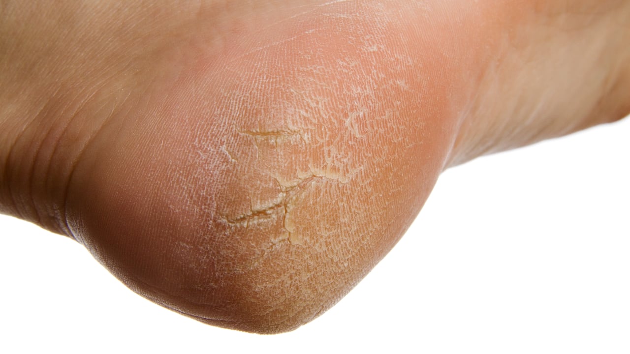 pies; sequedad; hiperqueratosis