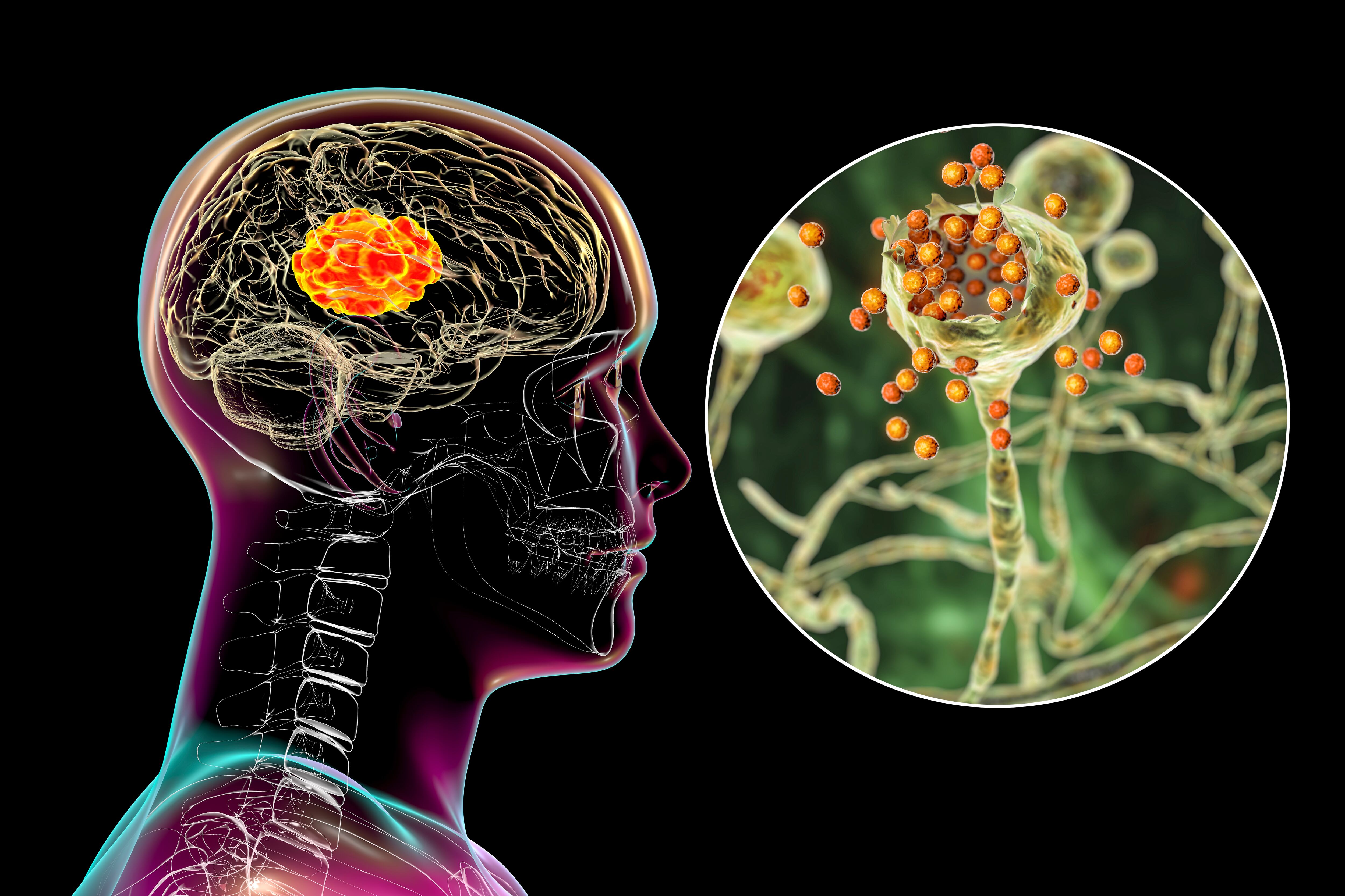 Algunos hongos cerebrales puede causar Alzheimer.