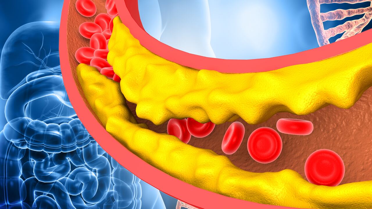 El colesterol elevado puede bloquear las arterias.