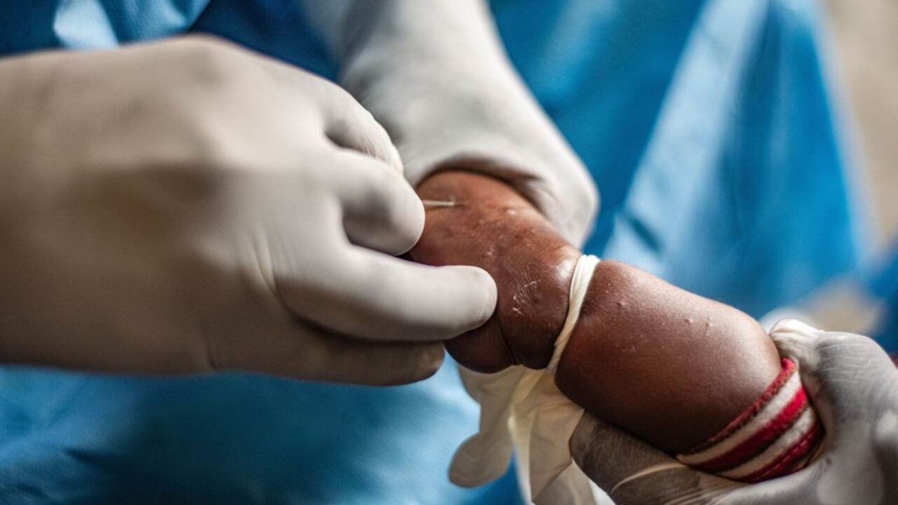 Un niño infectado con mpox recibe tratamiento en un hospital del territorio de Nyiragongo, cerca de Goma, provincia de Kivu del Norte, al este de la República Democrática del Congo, el 15 de agosto de 2024 (Foto de Zanem Nety Zaidi/Xinhua vía Getty Images)