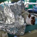 A person who was burned when a gasoline truck overturned and exploded lies in bed at the Justinien University Hospital in Cap-Haitien, Haiti, Tuesday, Dec. 14, 2021. The explosion engulfed cars and homes in flames, killing more than 50 people and injuring dozens of others. (AP Photo/Joseph Odelyn)