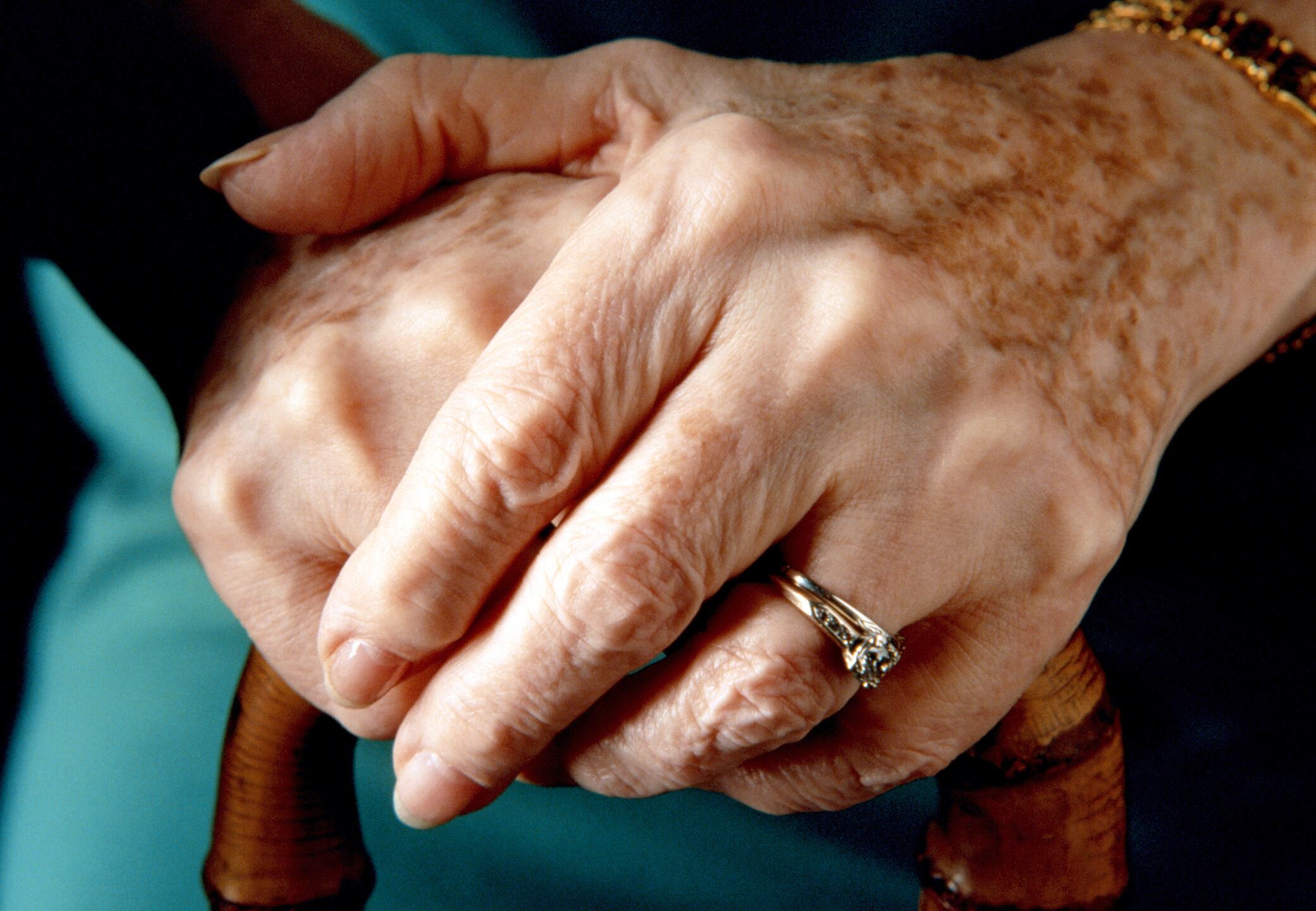 Manchas hepáticas - Adulto Mayor