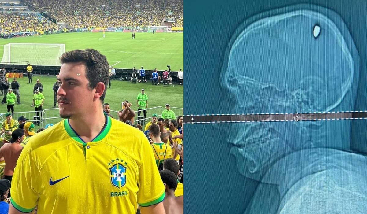 La radiografía mostró la bala en el cerebro