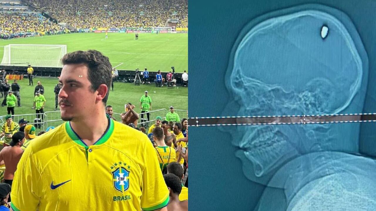 La radiografía mostró la bala en el cerebro.