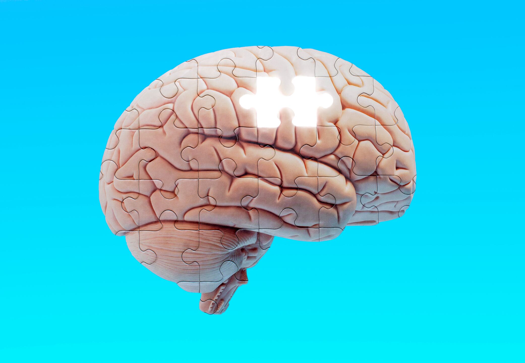 Foto de referencia sobre alzhéimer